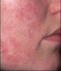 Erythema Erythema - redness caused by inflammation Telangiectasia /Couperosedilated/broken/distended capillaries