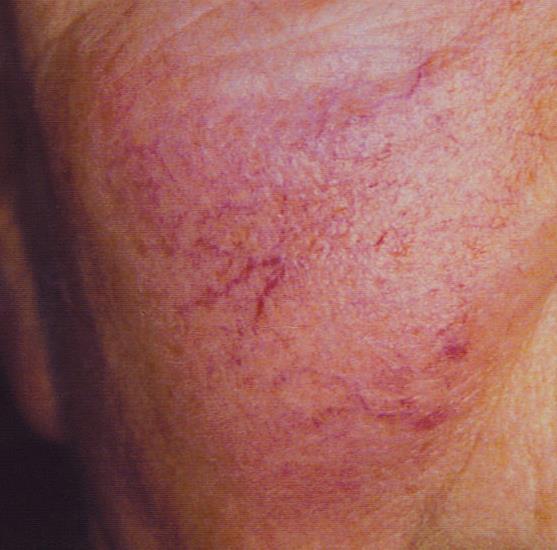redness - constant appearance of redness over skin Vascular- blood vessel related Vaso-dilation - expansion of