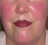 Rosacea Common skin disorder Vascular related to blood Sudden flushing of blood to the face Lasting 10 mins Red patches, pimples,