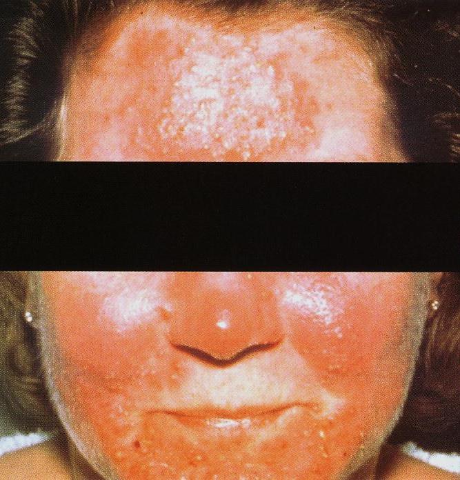 Rosacea triggers Sun exposure (22-61%) Heat Physical exertion (14%) Emotional stress (45%) Alcohol (especially red wine)