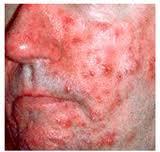 Larger than normal pimples domed Primarily on