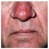 Subtypes/stages of Rosacea Subtype 3 Thickened appearance