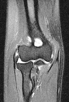 Failed Lateral Epicondylitis Surgery Post operative MRI ruptured LCL, continued lateral