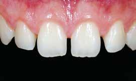 All-ceramic shells (veneers) Stained or slightly malpositioned teeth, or fractured front teeth can be treated with all-ceramic shells (veneers).