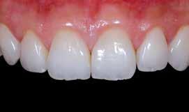 Before: Gaps in the front tooth row Veneers: Veneers are thin shells made of ceramic material which are bonded to the front surface of teeth (due to their