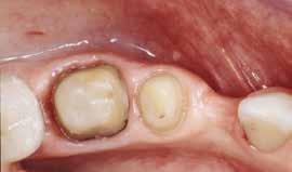 Crowns and bridges Crowns: A crown is used to entirely cover a severely damaged tooth. The crown replaces missing tooth structure or improves the tooth s alignment.
