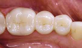 Before: Missing tooth with neighbouring tooth showing caries Crowns / Bridges: A crown replaces the natural crown of a tooth which cannot be restored with filling materials.