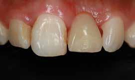 Implant restoration If a single tooth or several teeth are missing, artificial tooth roots (implants) are placed which serve as anchors for the replacement teeth.