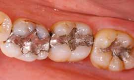 Tooth fillings If a tooth is only partially damaged due to e.g. caries, a filling or so-called inlay is usually sufficient to fix it.