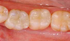 Dark fillings made of amalgam are a thing of the past. All-ceramic inlays cannot be distinguished from the natural tooth structure.