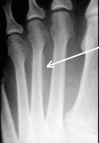 Stress fractures March fracture Unexplained swelling and pain after