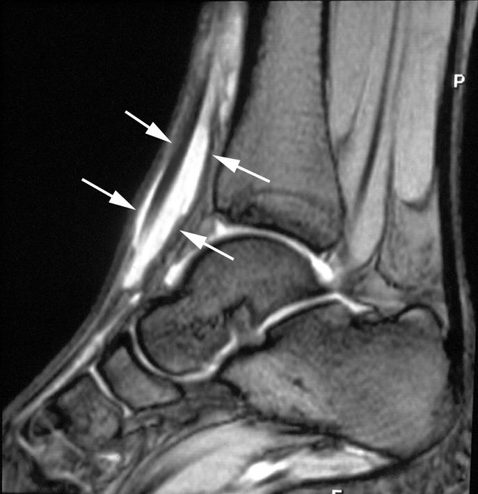 C HPTER 10 Figure 11. cute tenosynovitis of the tibialis anterior tendon in a 38year-old sportsman.
