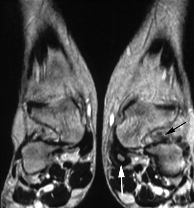 , xial T2-weighted fast spin-echo GRE MR image of the ankle shows the fluid (arrow) in the distended tendon sheath. Figure 12.