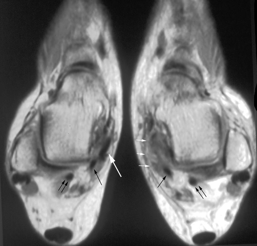 , Coronal T1-weighted GRE MR image at the level of the sinus tarsi (black arrow) showing accessory navicular bone on the medial side (white arrow).