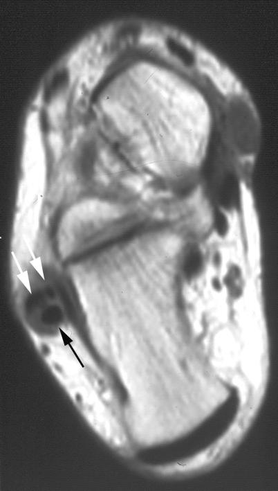 OVERUSE ND SPORTS-RELTED INJURIES Figure 13. Male runner, 41-year-old, with peroneal splits syndrome.