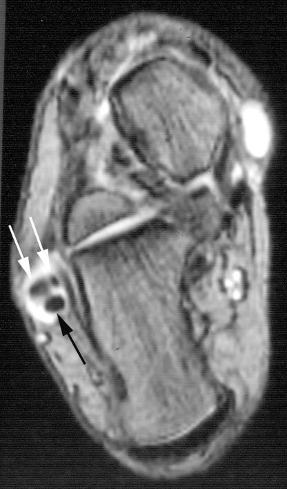There is enlarge-ment of the peroneal tendon sheath due to fluid with two peroneal brevis tendons (white arrows and one peroneus longus tendon (black arrow).