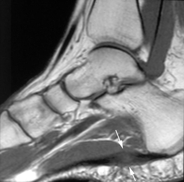 C HPTER 10 Figure 14. Plantar fasciitis in a 18-year-old jumper.