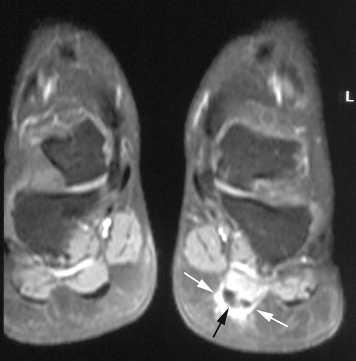 (arrows) of the plantar fascia near its attachment to the medial calcaneal tuberosity.