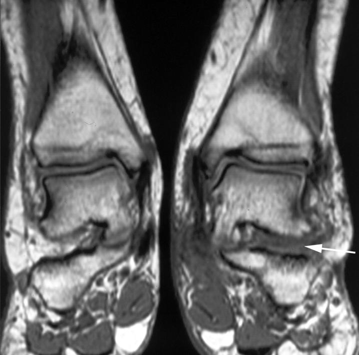 by edema (white arrows). The right ankle is normal. Figure 15.