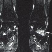 , T1-weighted coronal spin-echo MR image shows diffuse infiltration (arrow) of the left tarsal sinus