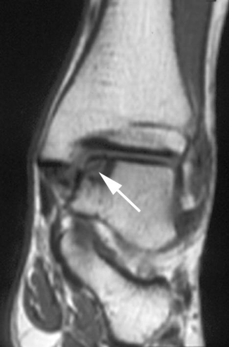 CHPTER 10 Figure 2. Male jumper with two years pain in the medial side of the ankle.