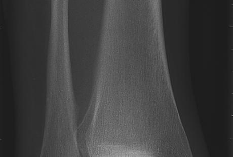 osteochondral fragment typical of loosening (arrows). Figure 3.