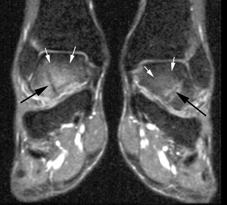 , Coronal CT of both hindfeet showing stress fractures (arrows).
