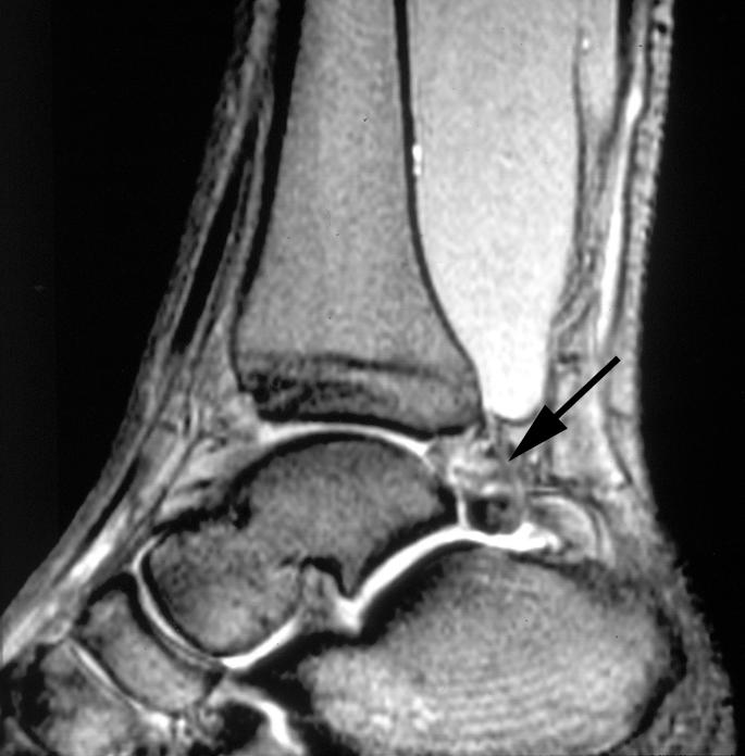 C HPTER 10 Figure 7. Posterior impingement syndrome in 24-year-old runner.
