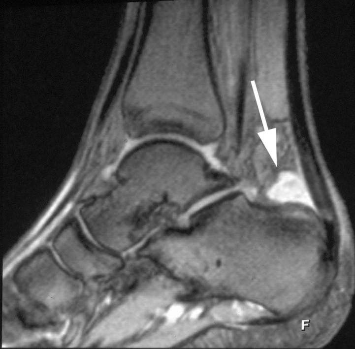 OVERUSE ND SPORTS-RELTED INJURIES Figure 9. Long distance runner, 29-year-old, with inflammation of the chilles tendon and retrocalcaneal bursitis.