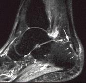 (arrowhead). Figure 10. Haglund syndrome in a 23-year-old female runner.
