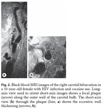 Subclinical vascular changes in HIV MRI Black Blood imaging demonstrating high rates