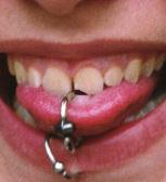 Complications of Oral Piercing and Wearing Oral Jewelry You may: Develop excessive saliva and drooling. Have difficulties saying words clearly. Have problems with chewing and swallowing food.