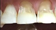 anterior teeth with premolars Fig