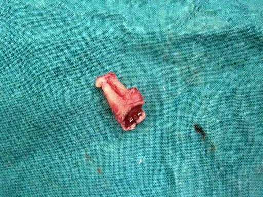 Case Report A 22 year old male patient reported to Department of Oral and Maxillofacial Surgery, King George s Medical University with chief complaint of pain and decayed lower left molar teeth.
