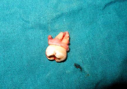 donor tooth. The option of autotransplantion along with other options was explained to the patient.