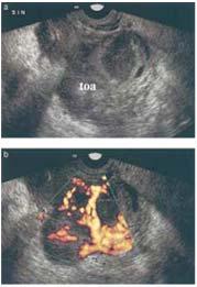 Doppler Ultrasound Predictive findings vs hydrosalpinges: Doppler hyperemia & lower