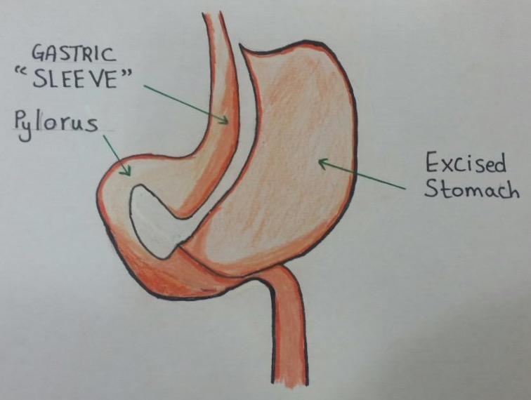 Gastric bypass, roux en-y (distal) The small intestine is normally 6 10 m (20 33 ft.) in length.