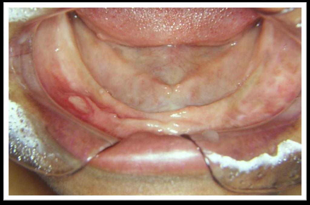 Common oral mucosal