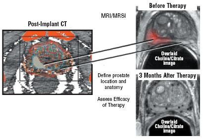 Figure 7. On the right side are two representative axial MRI/MRSI images (cancer in red) taken prior to (top) and after Brachytherapy (bottom).