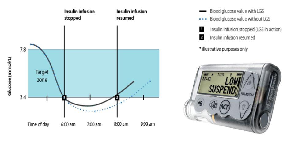 BENEFITS INSULIN PUMP THERAPY: CONTINUOUS GLUCOSE MONITORING