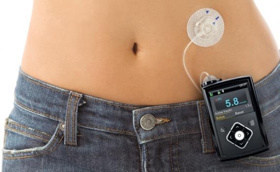 AGENDA Why Insulin Pump Therapy Pump Therapy Overview
