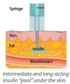 There are limitations of insulin injection therapy MDI CSII Disease progression - High doses of insulin are required to meet glycemic goals 1 -