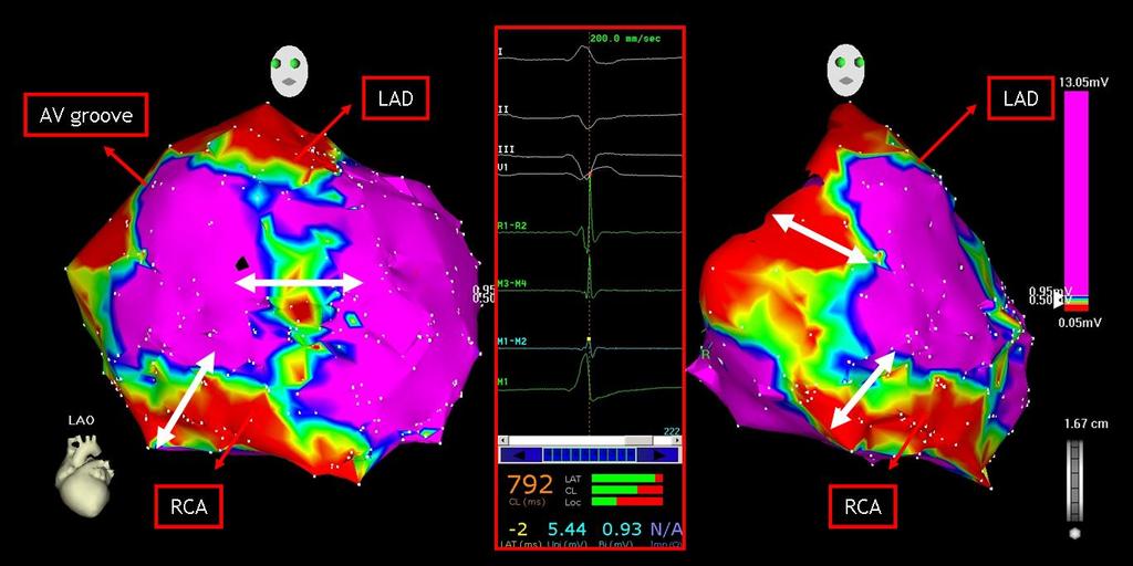 Epicardium Normal Heart (8pts) From Fat/Coronaries or Normal RV/LV Rare - Wide Egs > 80mS 2.2% Split Egs - 0.