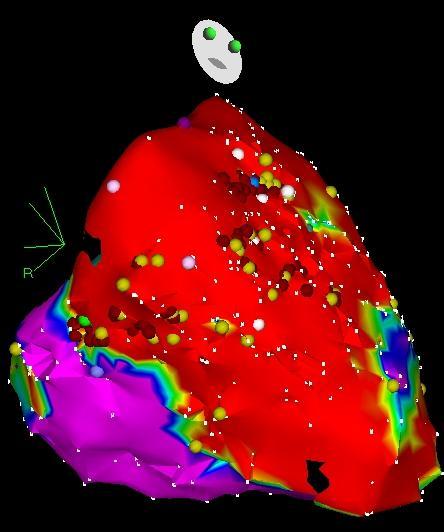 V6 Distal Prox ARVC - Epicardial Ablation Targets 1)Late Potentials and 2)Pacemap
