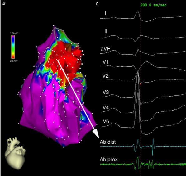 VT Ablation in Non-ischemic CM Endocardial substrate Mechanism of VT: reentry Less than 25% of endocardial surface Abnormal endocardial