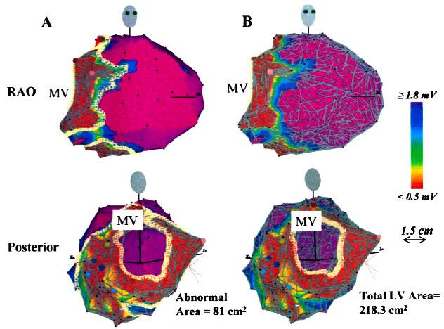 Estimation of the Abnormal LV Endocardium in a patient with