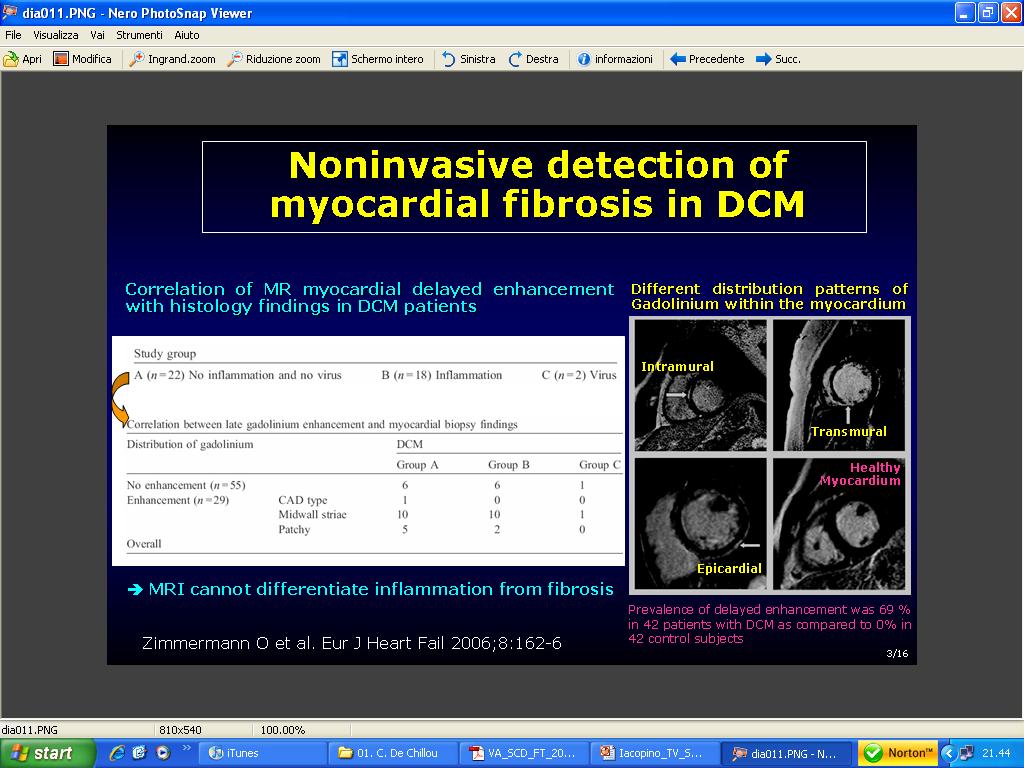 Non Invasive Detection of Myocardial Fibrosis in DCM Correlation of MR myocardial delayed enhancement with histology findings in DCM Different distribution patterns of Gadolinium within the