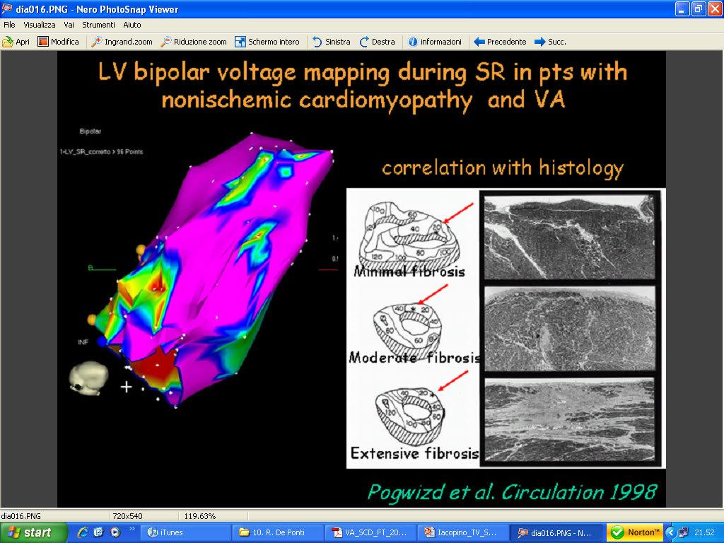 LV Bipolar Voltage Mapping During SR in