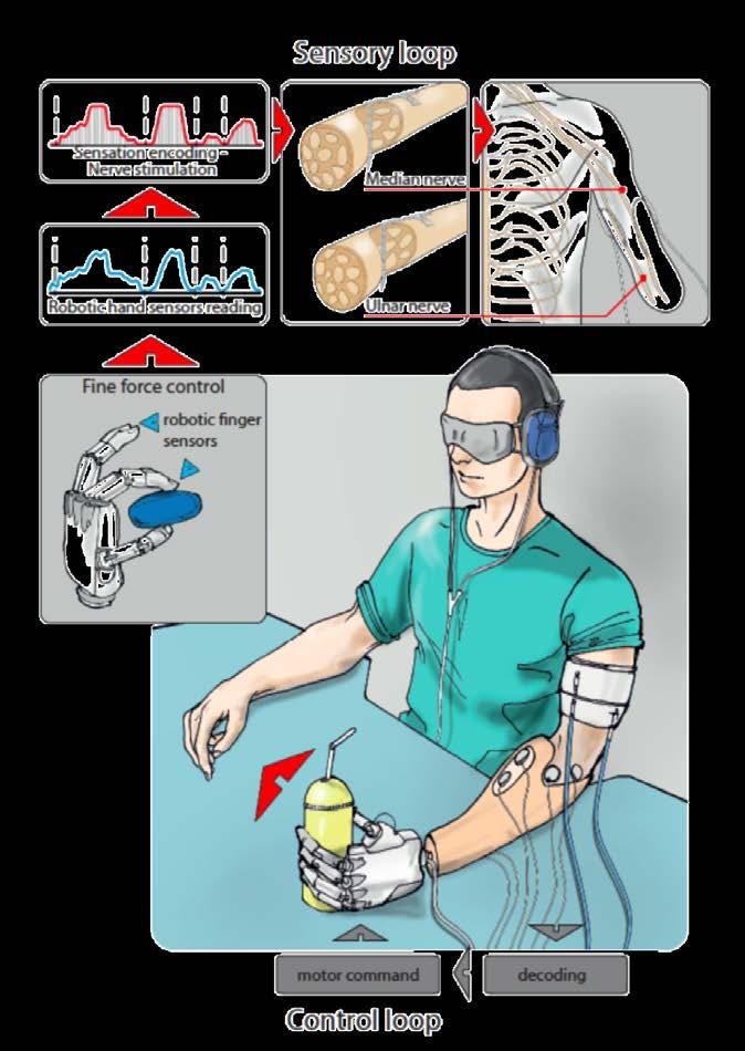 Sensory feedback in bidirectional hand prostheses poor sensory feedback available