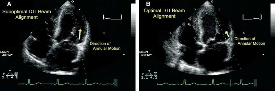 47 Figure 2: Suboptimal and optimal annular Doppler tissue imaging (TDI) beam alignment. A: Large angle of insonation (increased cosine) between Doppler beam and lateral annulus.
